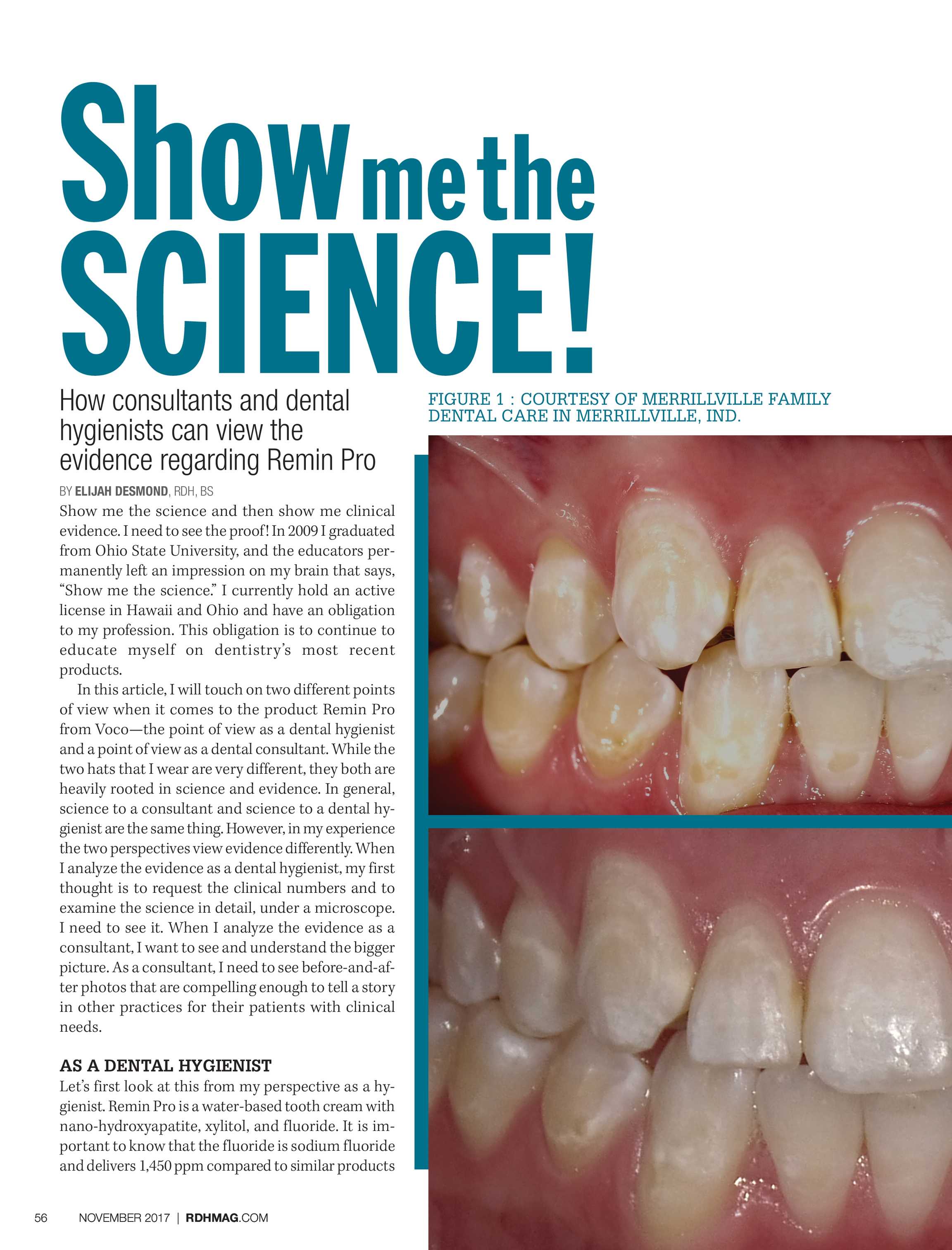 hydroxyapatite toothpaste before and after